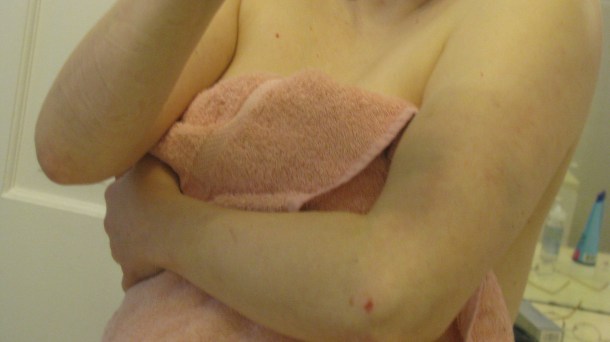 left upper arm and elbow 120813